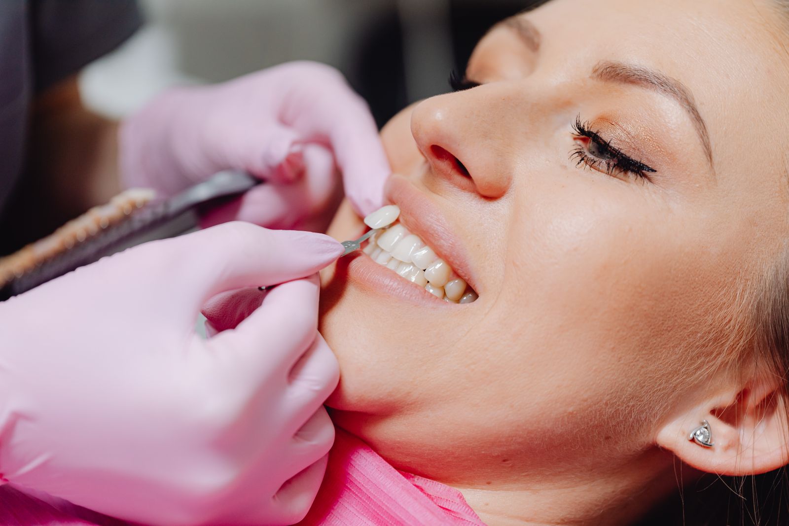 Dental veneers being applied during a cosmetic dentistry procedure