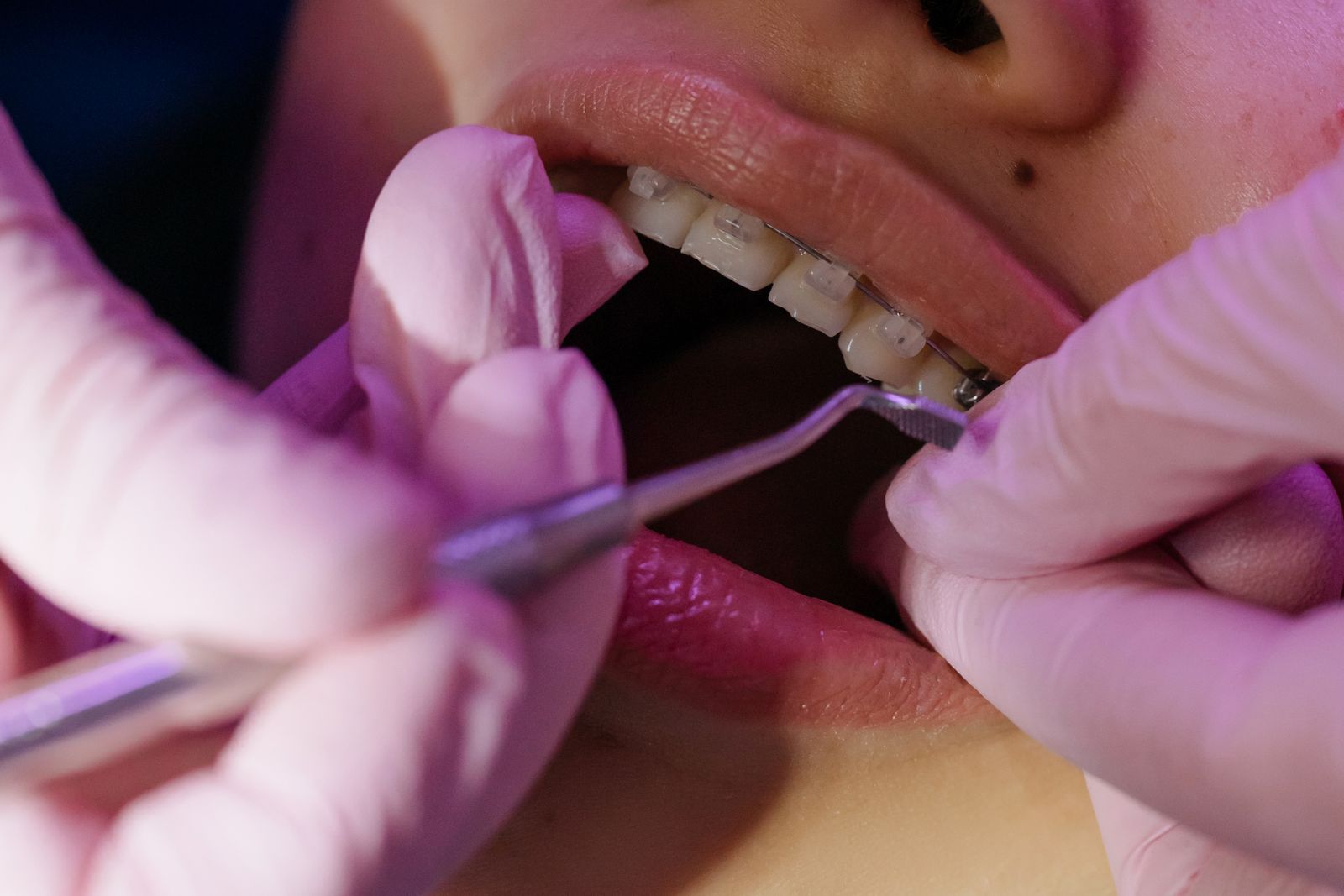 Orthodontist examining a patient's ceramic braces during an adjustment appointment