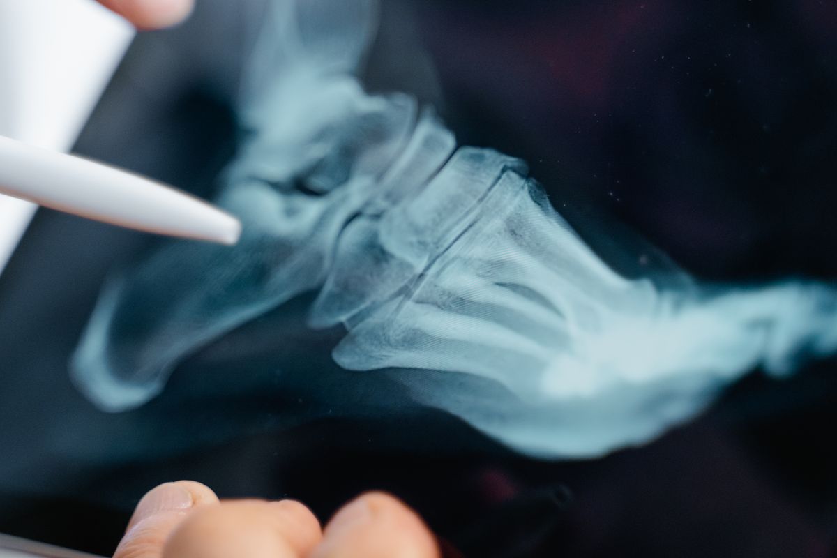 Close-up of a hand pointing to a foot X-ray, highlighting the bone detail orthopedic surgeons review with patients